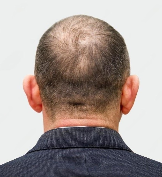 head-balding-man-before2